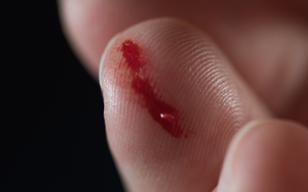 Tratamento de Feridas – APLICAÇÕES DO PRP